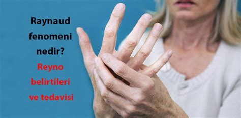 raynaud hastalığı nedir belirtileri